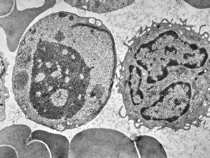 M,38y. | blood, myeloid leukemia M,38y. | blood, myeloid leukemia